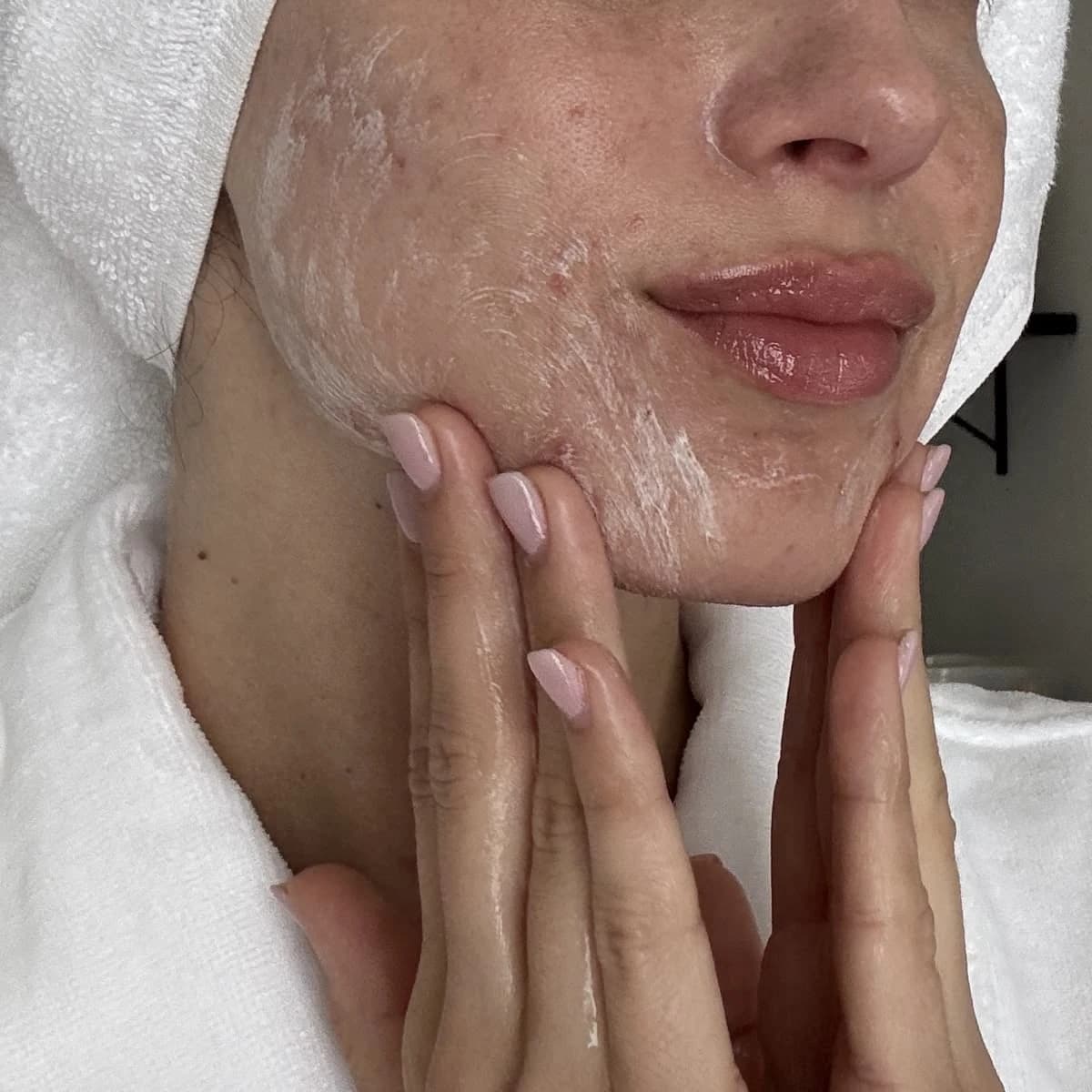 Application d'une crème sur une peau à imperfections